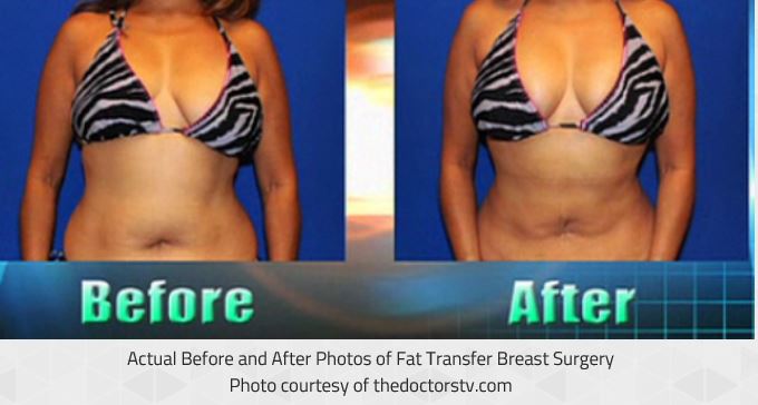 uneven breasts surgery before and after