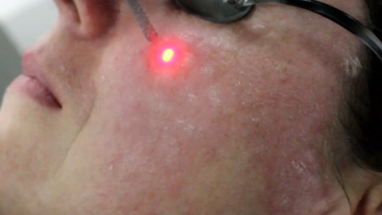 laser-face-treatment