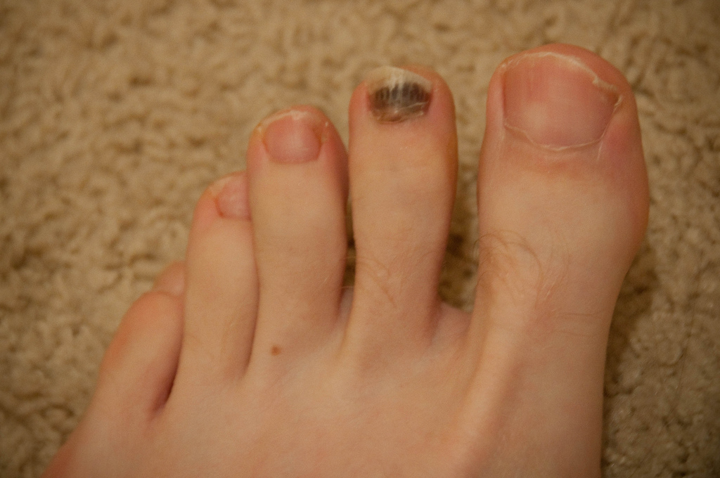 Why Did My Dog S Toenail Turn Black