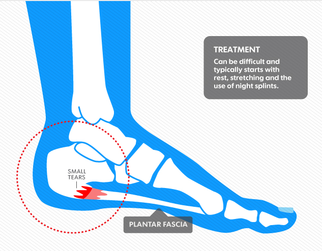 plantar